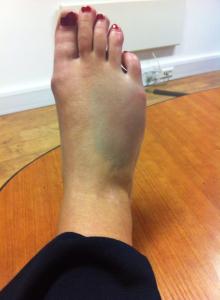 broken foot day 1